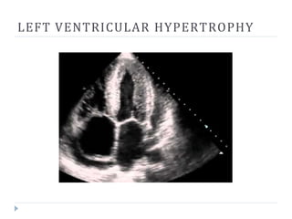LEFT VENTRICULAR HYPERTROPHY
 