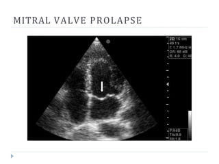 MITRAL VALVE PROLAPSE
 