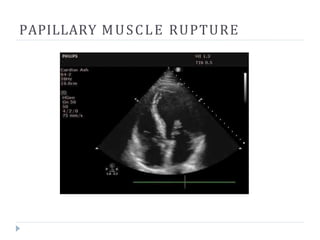 PAPILLARY MUSCLE RUPTURE
 