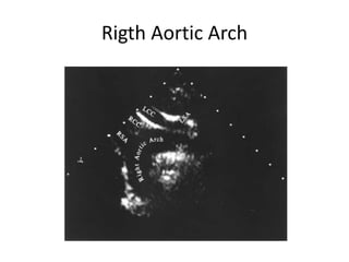 Rigth Aortic Arch
 
