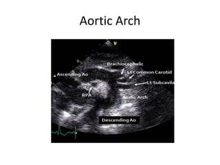 Aortic Arch
 