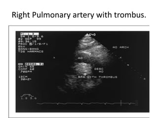 Right Pulmonary artery with trombus.
 