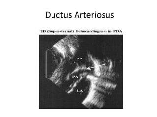 Ductus Arteriosus
 