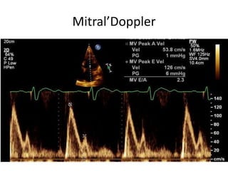 Mitral’Doppler
 