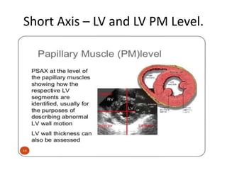 Short Axis – LV and LV PM Level.
 