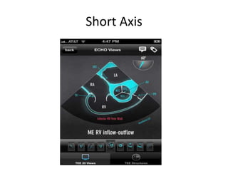 Short Axis
 