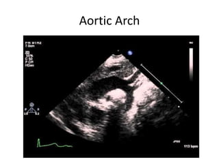 Aortic Arch
 