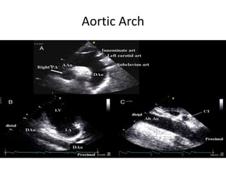 Aortic Arch
 