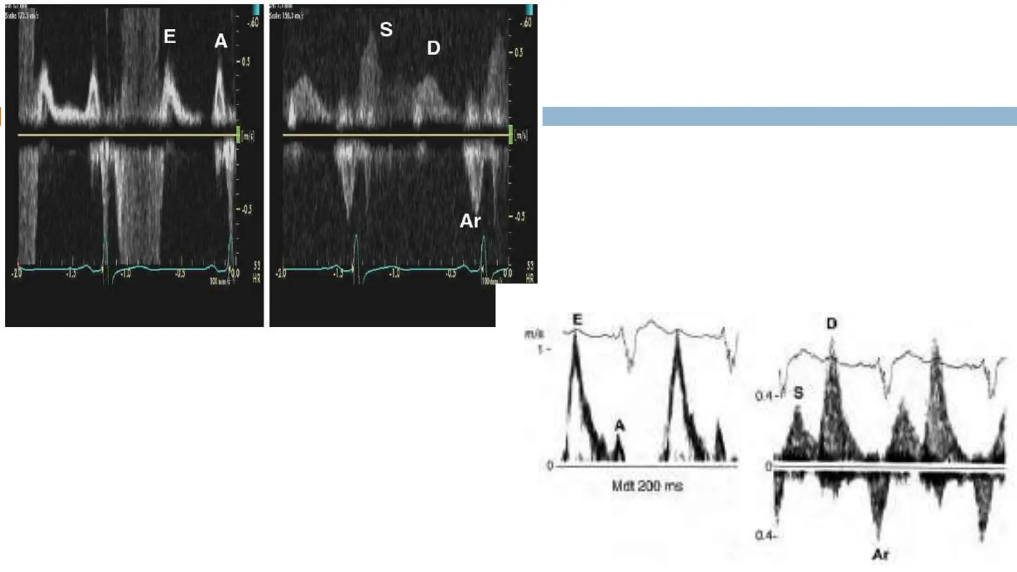 ECHOCARDIOGRAPHIC ASSESMENT OF DIASTOLIC FUNCTION.pptx