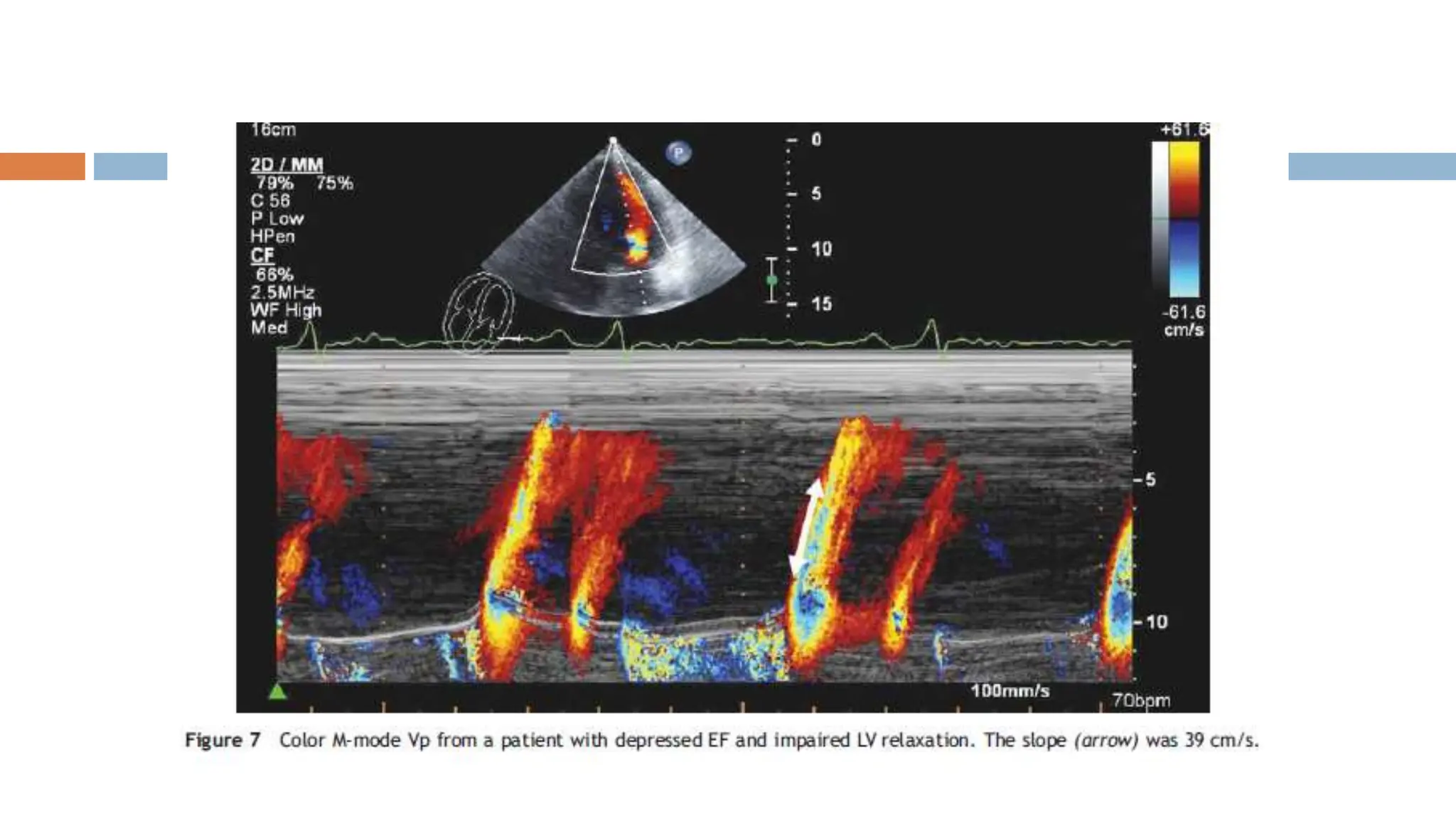 ECHOCARDIOGRAPHIC ASSESMENT OF DIASTOLIC FUNCTION.pptx