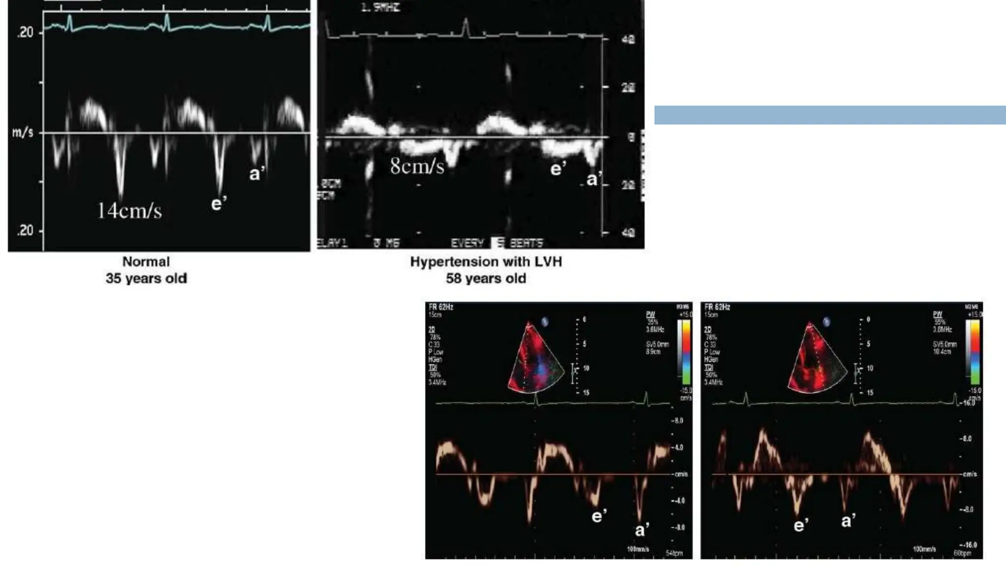 ECHOCARDIOGRAPHIC ASSESMENT OF DIASTOLIC FUNCTION.pptx