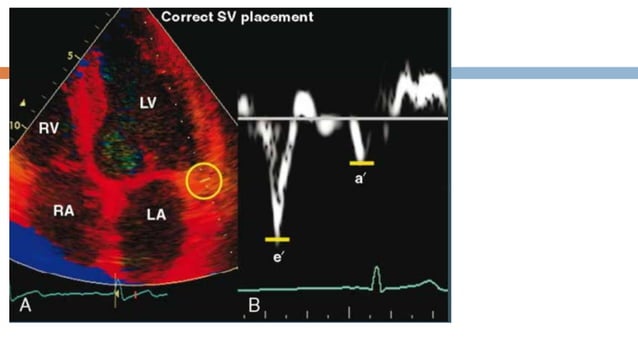 ECHOCARDIOGRAPHIC ASSESMENT OF DIASTOLIC FUNCTION.pptx