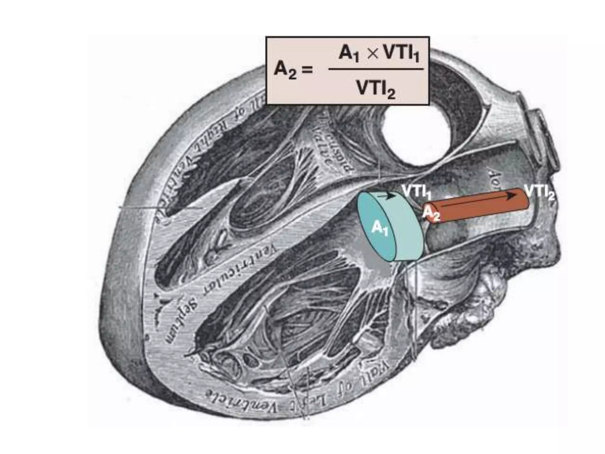 Echocardiographic assessment of aortic stenosis | PPTX