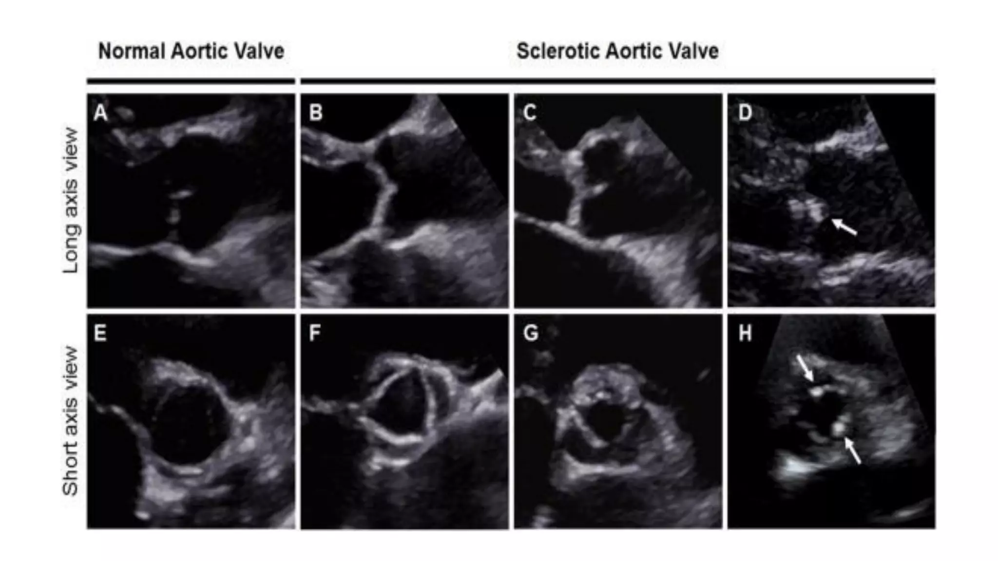Echocardiographic evaluation of aortic valve and Aortic stenosis | PDF