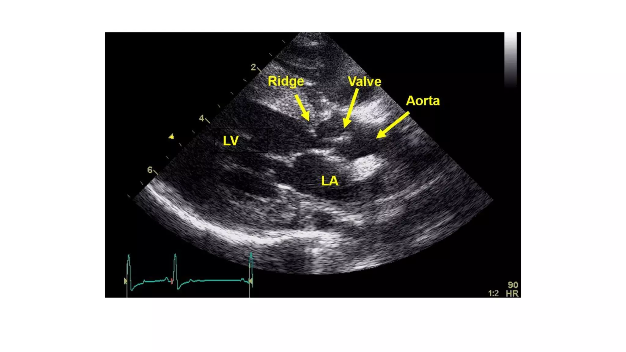 Echocardiographic evaluation of aortic valve and Aortic stenosis | PDF