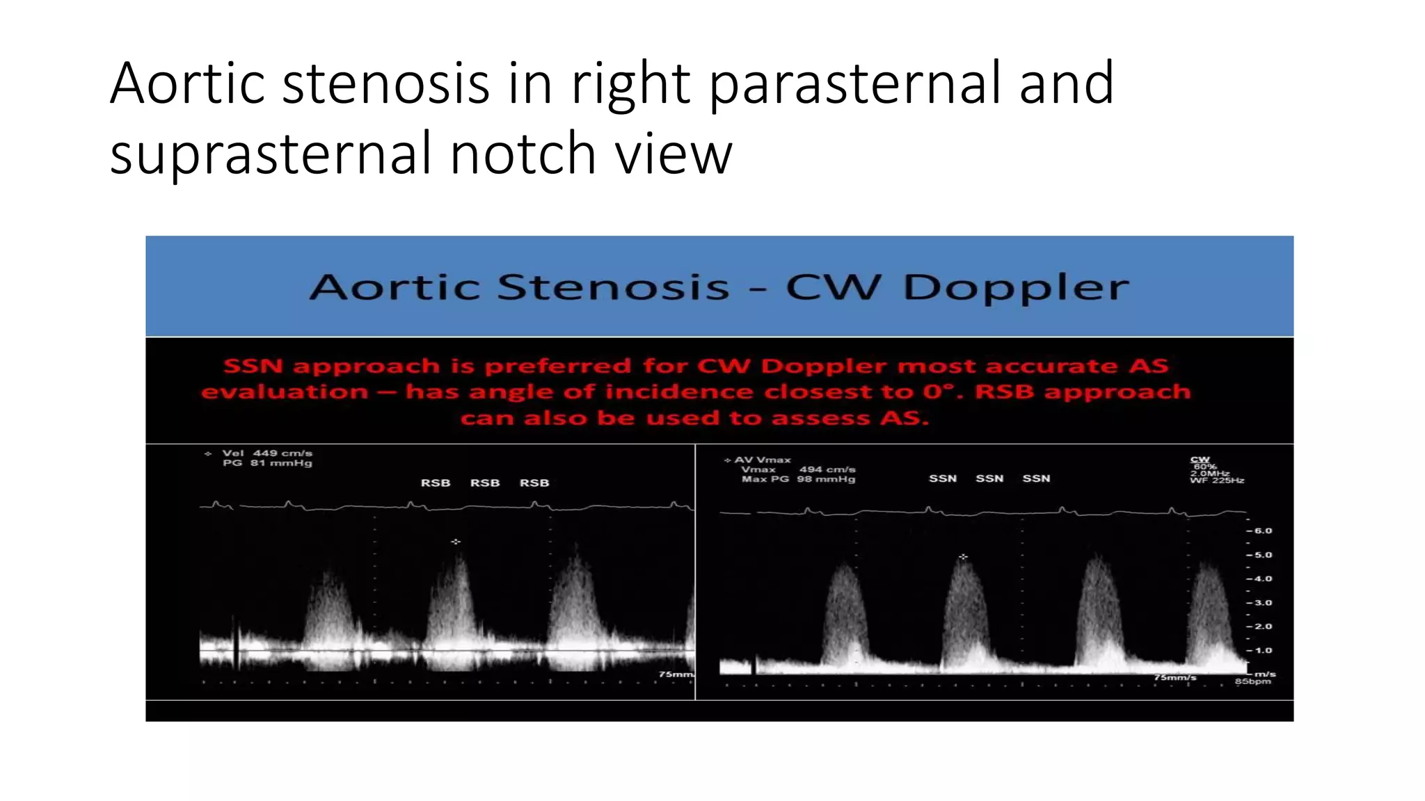 Echocardiographic Evaluation Of Aortic Valve And Aortic Stenosis PDF Echocardiographic Evaluation Of Aortic Valve And Aortic Stenosis PDF