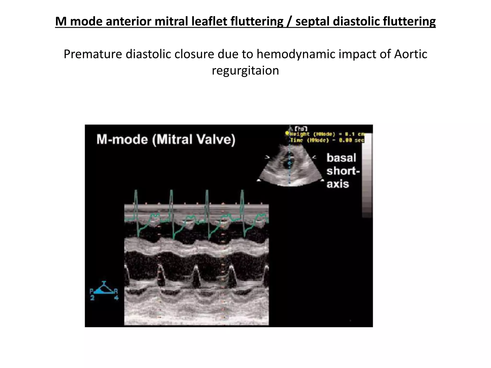 Echocardiographic evaluation of aortic regurgitation | PDF