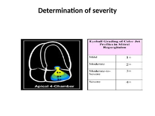 echocardiographic evaluation of mitral regurgitation pptx | PPTX