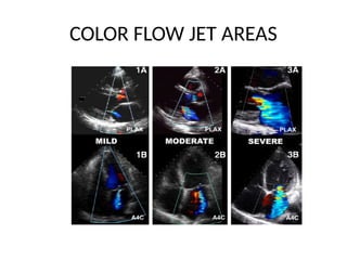 echocardiographic evaluation of mitral regurgitation pptx | PPTX