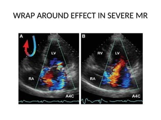 echocardiographic evaluation of mitral regurgitation pptx | PPTX