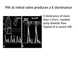 echocardiographic evaluation of mitral regurgitation pptx | PPTX