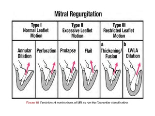 echocardiographic evaluation of mitral regurgitation pptx | PPTX