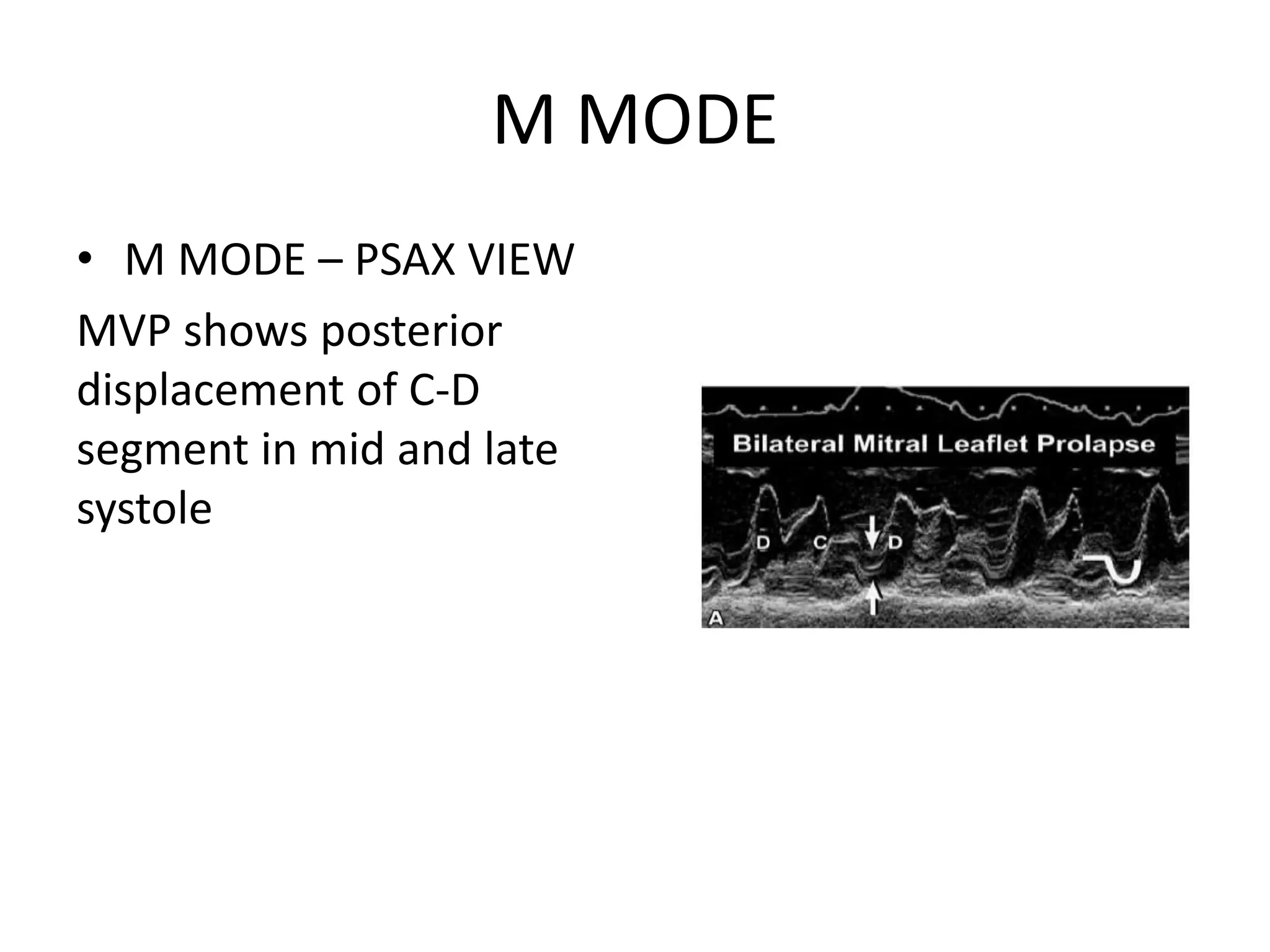 Echocardiographic evaluation of mitral regurgitation | PPTX