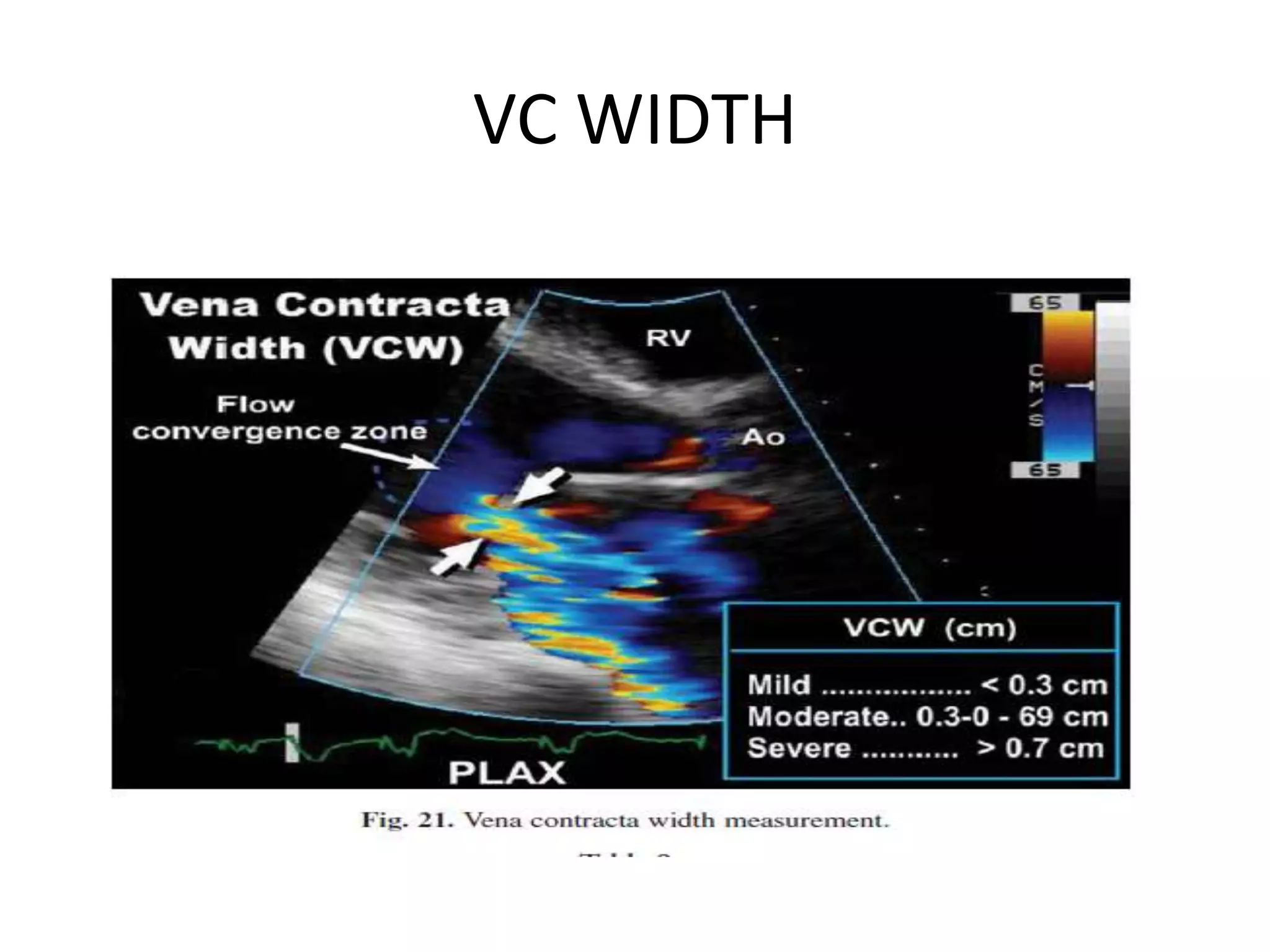 Echocardiographic evaluation of mitral regurgitation | PPTX