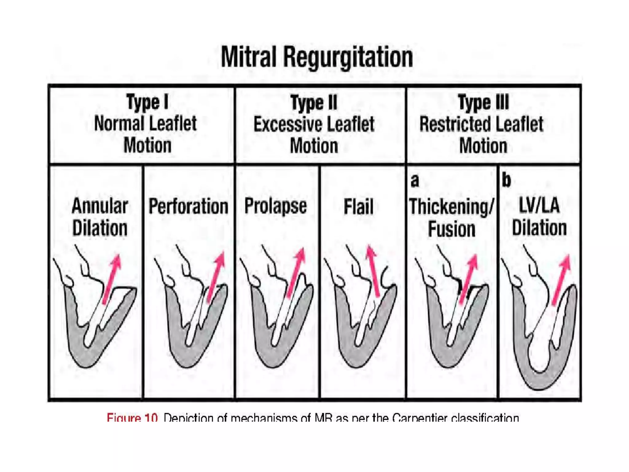 Echocardiographic evaluation of mitral regurgitation | PPTX