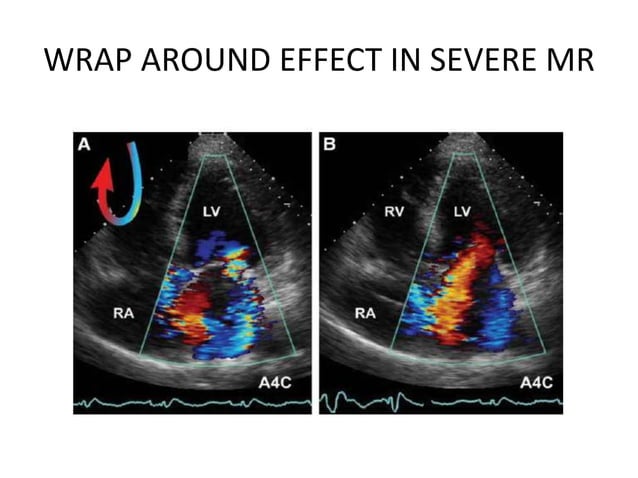 Echocardiographic evaluation of mitral regurgitation | PPTX | Heart and ...