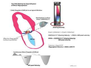 Echocardiographic evaluation of mitral regurgitation | PPTX