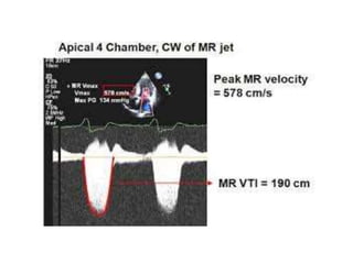 Echocardiographic evaluation of mitral regurgitation | PPTX