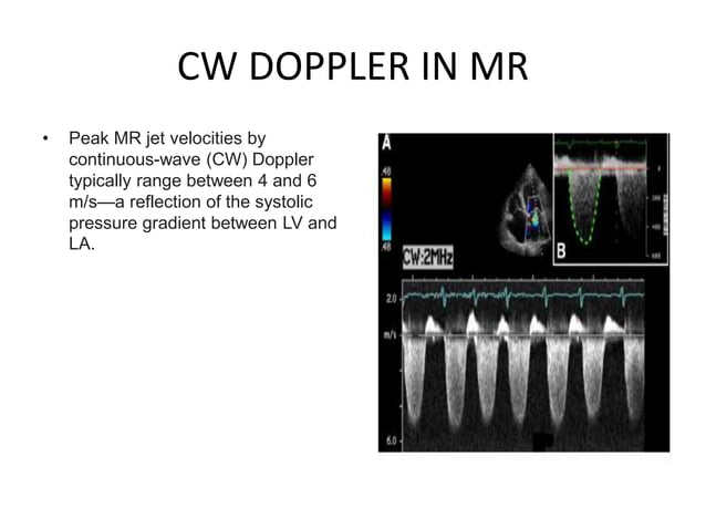 Echocardiographic evaluation of mitral regurgitation | PPTX | Heart and ...