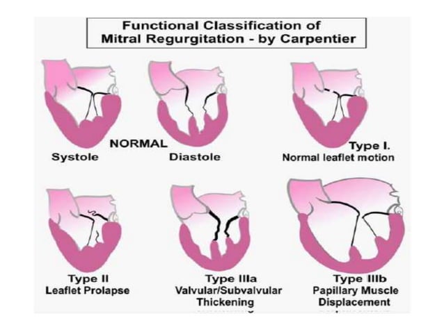 Echocardiographic evaluation of mitral regurgitation | PPTX | Heart and ...