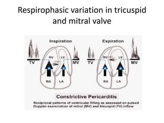 Respirophasic Variation Examples Echocardiographic evaluation of pericardium | PDF