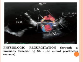 PHYSIOLOGIC REGURGITATION through a
normally functioning St. Jude mitral prosthesis
(arrows)
 