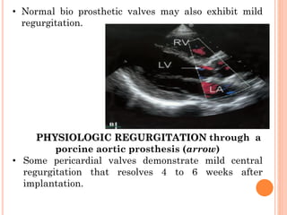 • Normal bio prosthetic valves may also exhibit mild
regurgitation.
PHYSIOLOGIC REGURGITATION through a
porcine aortic prosthesis (arrow)
• Some pericardial valves demonstrate mild central
regurgitation that resolves 4 to 6 weeks after
implantation.
 