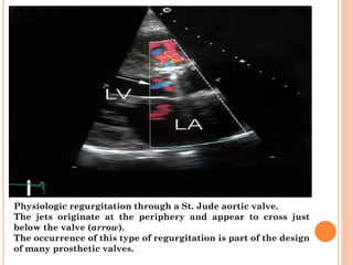 Physiologic regurgitation through a St. Jude aortic valve.
The jets originate at the periphery and appear to cross just
below the valve (arrow).
The occurrence of this type of regurgitation is part of the design
of many prosthetic valves.
 