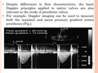 • Despite differences in flow characteristics, the basic
Doppler principles applied to native valves are also
relevant to the study of prosthetic valves.
• For example, Doppler imaging can be used to measure
both the maximal and mean pressure gradient across
prostheses (Fig.).
 