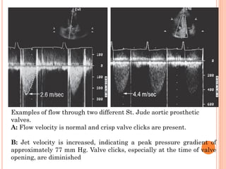 Examples of flow through two different St. Jude aortic prosthetic
valves.
A: Flow velocity is normal and crisp valve clicks are present.
B: Jet velocity is increased, indicating a peak pressure gradient of
approximately 77 mm Hg. Valve clicks, especially at the time of valve
opening, are diminished
 