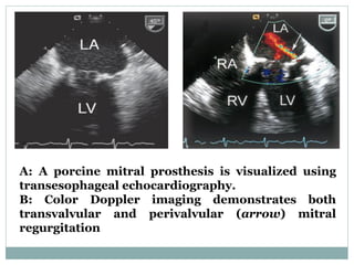 A: A porcine mitral prosthesis is visualized using
transesophageal echocardiography.
B: Color Doppler imaging demonstrates both
transvalvular and perivalvular (arrow) mitral
regurgitation
 
