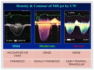 INCOMPLETE OR
FAINT
DENSE DENSE
PARABOLIC USUALLY PARABOLIC EARLY PEAKING,
TRIANGULAR
 