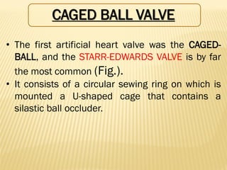 CAGED BALL VALVE
• The first artificial heart valve was the CAGED-
BALL, and the STARR-EDWARDS VALVE is by far
the most common (Fig.).
• It consists of a circular sewing ring on which is
mounted a U-shaped cage that contains a
silastic ball occluder.
 
