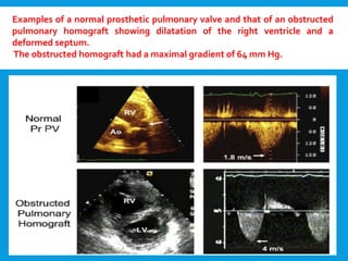 Examples of a normal prosthetic pulmonary valve and that of an obstructed
pulmonary homograft showing dilatation of the right ventricle and a
deformed septum.
The obstructed homograft had a maximal gradient of 64 mm Hg.
 