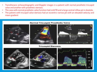 • Transthoracic echocardiographic and Doppler images in a patient with normal prosthetic tricuspid
valve and another with prosthetic stenosis.
• The case with normal prosthetic valve function had mildTR and a large central inflow jet in diastole.
• The patient with tricuspid valve stenosis had an eccentric narrow jet with an elevated velocity and
mean gradient
 