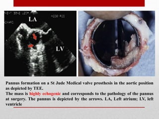 Pannus formation on a St Jude Medical valve prosthesis in the aortic position
as depicted by TEE.
The mass is highly echogenic and corresponds to the pathology of the pannus
at surgery. The pannus is depicted by the arrows. LA, Left atrium; LV, left
ventricle
 