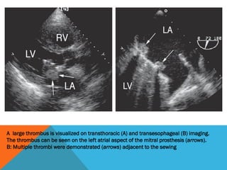 A large thrombus is visualized on transthoracic (A) and transesophageal (B) imaging.
The thrombus can be seen on the left atrial aspect of the mitral prosthesis (arrows).
B: Multiple thrombi were demonstrated (arrows) adjacent to the sewing
 