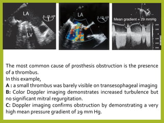 The most common cause of prosthesis obstruction is the presence
of a thrombus.
In this example,
A : a small thrombus was barely visible on transesophageal imaging
B: Color Doppler imaging demonstrates increased turbulence but
no significant mitral regurgitation.
C: Doppler imaging confirms obstruction by demonstrating a very
high mean pressure gradient of 29 mm Hg.
 