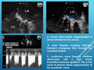 A, severe fibrocalcific degeneration is
demonstrated by the arrows.
B, color Doppler imaging indicates
turbulent antegrade flow through the
calcified leaflets.
C, continuous wave Doppler confirms
obstruction with a high mean
transmitral pressure gradient. This is the
result of primary tissue degeneration of
the prosthetic valve.
 