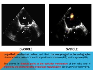 caged-ball mechanical valves and their transesophageal echocardiographic
characteristics taken in the mitral position in diastole (UR) and in systole (LR).
The arrows in diastole point to the occluder mechanism of the valve and in
systole to the characteristic physiologic regurgitation observed with each valve.
DIASTOLE SYSTOLE
 
